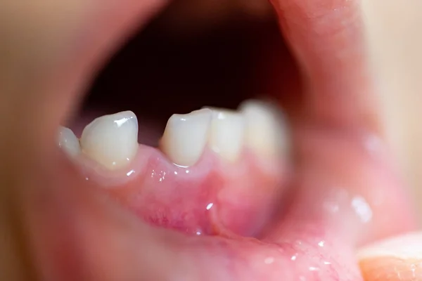 Close Wobbled Child Front Milk Teeth — Stock Photo, Image