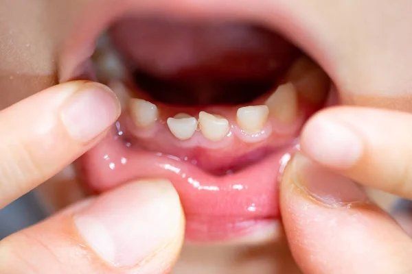 Primer Plano Los Dientes Leche Delanteros Del Niño Tambaleado — Foto de Stock