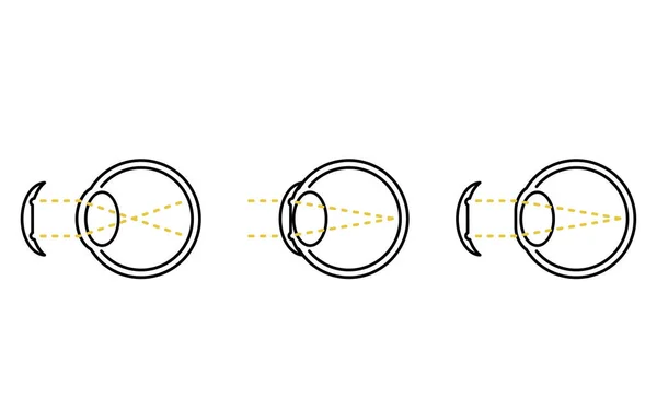 Jak Działają Soczewki Korekcyjne Wzroku Soczewki Ortopedyczne Brak Tekstu — Wektor stockowy