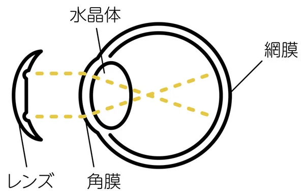 Illustration Orthokeratology Vision Correction Lenses Fitting Translation Lens Lens Retina — Stock Vector