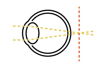 Görsel Keskinlik ve Kırılma Hatasının Tıbbi İllüstrasyonu, Hiperopya (retinanın arkasındaki odak)