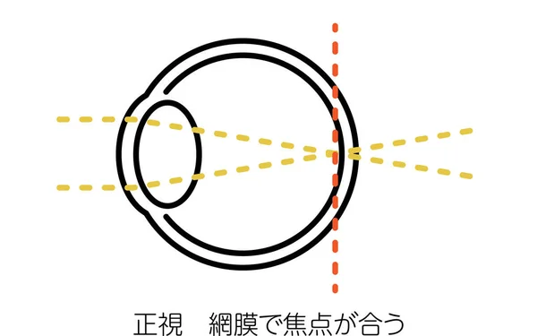 视力和屈光错误的医学说明 矫形器 聚焦于视网膜 矫形器 聚焦于视网膜 — 图库矢量图片