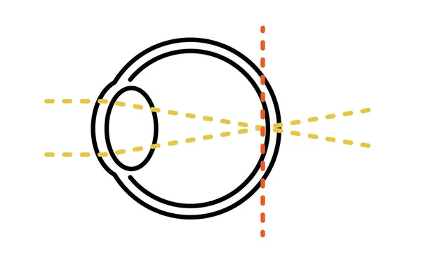 Ilustración Médica Agudeza Visual Error Refractivo Ortopía Enfoque Retina — Archivo Imágenes Vectoriales