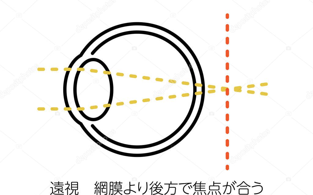 Medical Illustration of Visual Acuity and Refractive Error, Hyperopia (focus behind the retina) - Translation: Farsightedness (focus behind the retina)