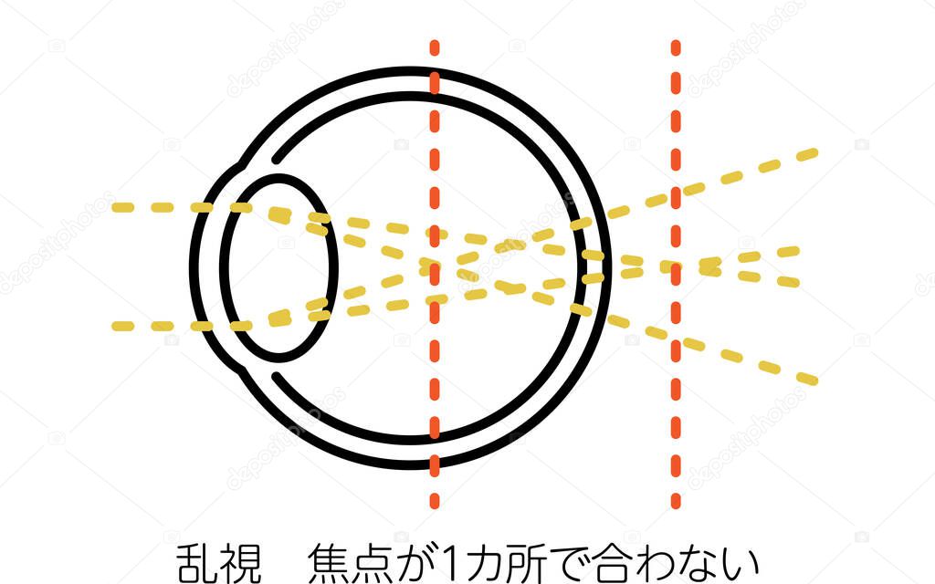 Medical Illustration of Visual Acuity and Refractive Error, Astigmatism (not in focus in one place) - Translation: Astigmatism (not in focus in one place)