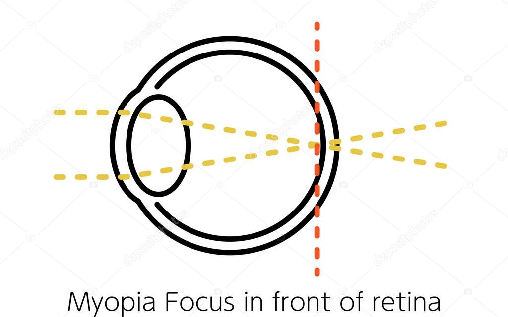 Medical Illustration of Visual Acuity and Refractive Error, Orthopia (focus at the retina)