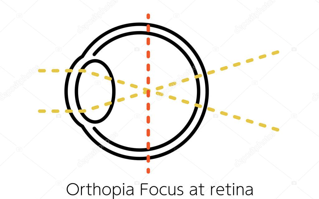 Medical Illustrations of Vision and Refractive Errors, by Myopia (focus in front of the retina)
