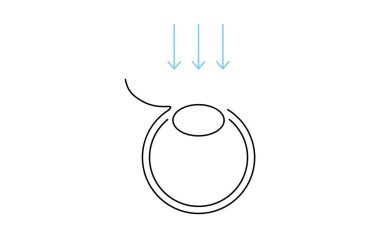LASIK ve kırılma ameliyatının tıbbi çizimi