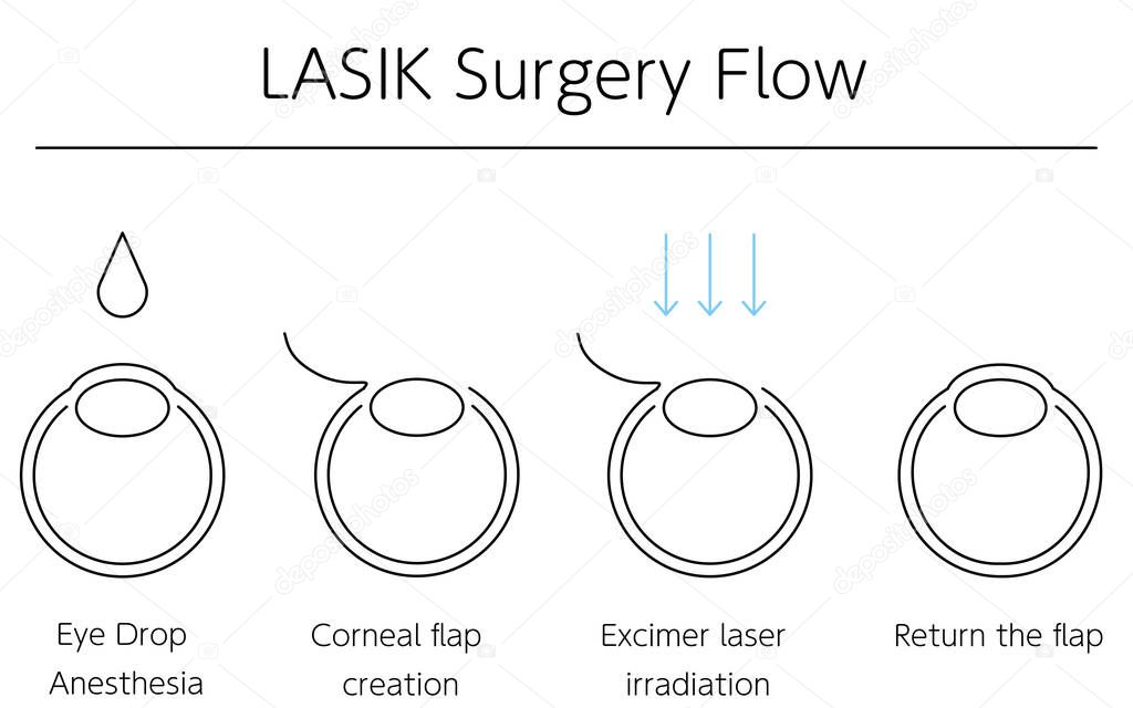 Medical illustration of LASIK and refractive surgery