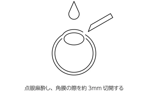 Icl 眼内コンタクトレンズ 手術と切開のイラスト 眼内麻酔で麻酔をかけ 角膜で約3Mmの切開を行う — ストックベクタ