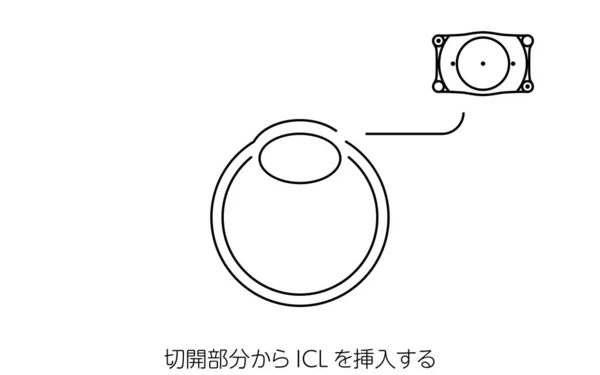 Icl Intraocular Lens Ameliyatı Icl Yerleştirme Çevirisi Nsizyon Yoluyla Icl — Stok Vektör