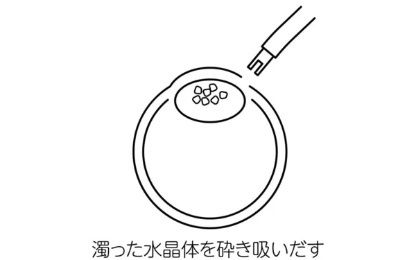 Chirurgie Cataracte Illustration Dessin Trait Succion Lentille Nuageuse Traduction Succion — Image vectorielle