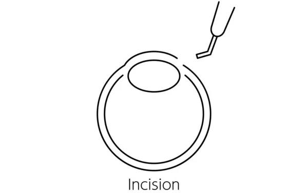 Chirurgie Cataracte Processus Illustration Dessin Trait Faire Une Incision — Image vectorielle