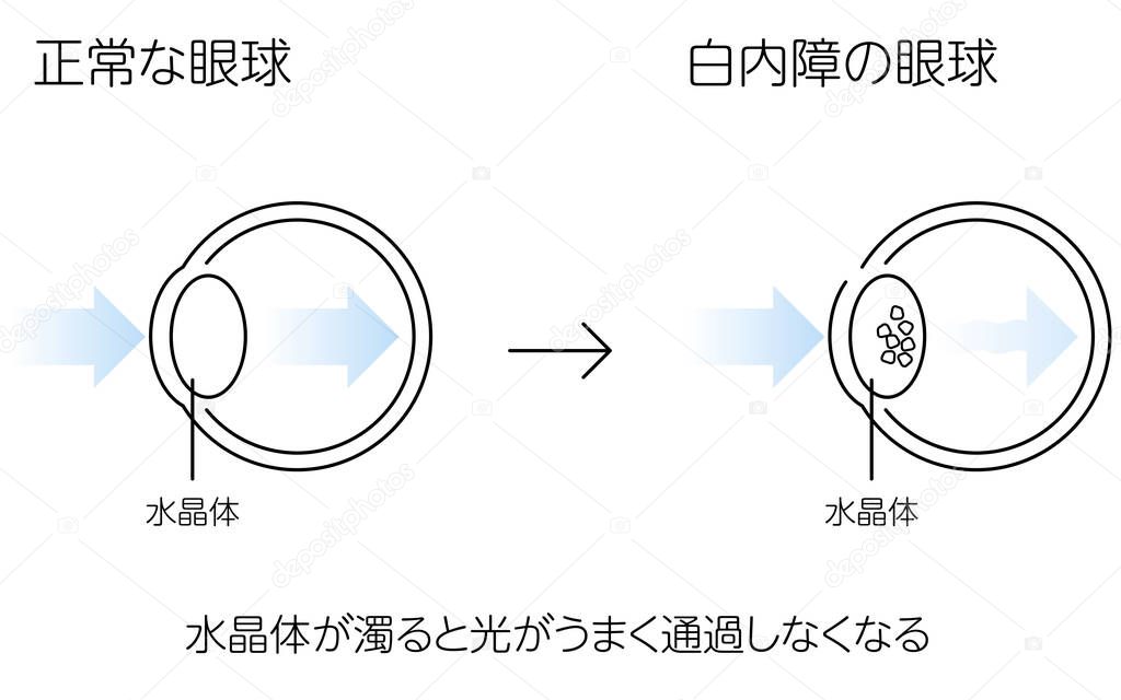 Normal and cataractous eye, illustration (line drawing) - Translation: normal eye, cataractous eye, lens, light cannot pass through the lens properly when the lens is cloudy