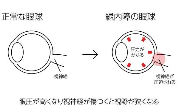 Ilustracja Działania Jaskry Oczu Normalnych Jaskry Ilustracja Medyczna Tłumaczenie Normalne — Wektor stockowy