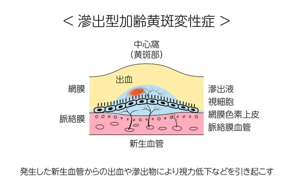 眼疾患 前立腺年齢関連の黄斑変性図 正常状態 前立腺年齢関連の黄斑変性 視力障害の原因となる血管の出血や異常 — ストックベクタ