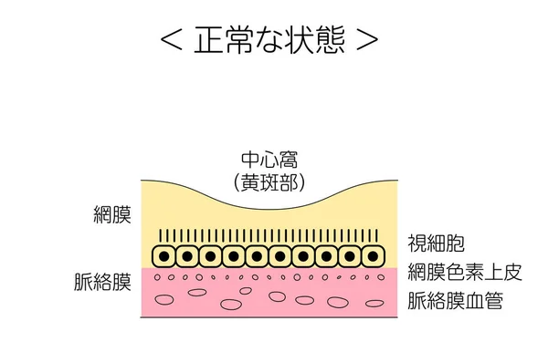 眼疾患 年齢関連の黄斑変性のイラスト 通常の状態 脈絡膜 中央の化石 Macula 光受容体細胞 網膜色素上皮 脈絡膜血管 — ストックベクタ