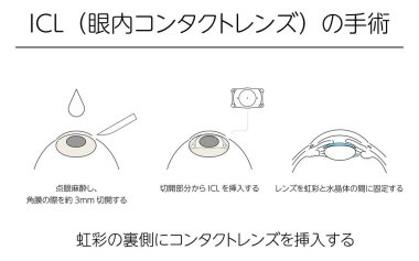 İllüzyon, ICL (intraoküler kontak lens) ile görüşün düzeltilmesi, Tıbbi illüstrasyon. * Çeviri: intraoküler lens (ICL) ameliyatı, lensin irisin arkasına yerleştirilmesi, oftalmik anestezi, korneada yapılan kesik, 