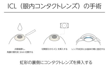Illustration, Correction of vision with ICL (intraocular contact lens), Medical illustration. - Translation: intraocular contact lens (ICL) surgery, insertion of contact lens behind the iris, ophthalmic anaesthesia, incision made at the cornea about  clipart
