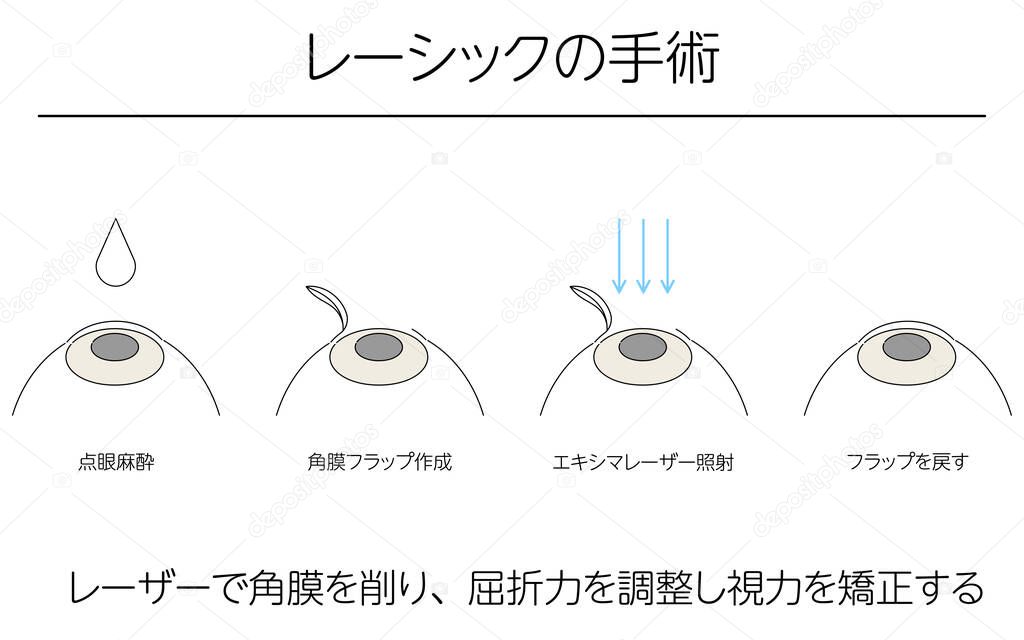 Illustration, LASIK vision correction, medical illustration. - Translation: LASIK surgery, laser shaving of the cornea to adjust refractive power and correct vision, ophthalmic anaesthesia, corneal flap creation, excimer laser radiation, return of fl