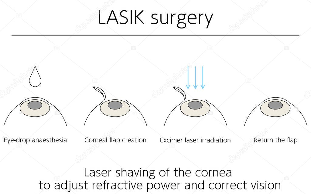 Illustration, LASIK vision correction, medical illustration.