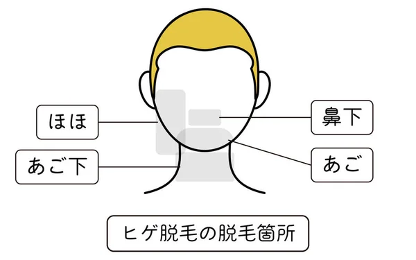 Illustration Hair Removal Areas Beard Hair Removal Translation Cheeks Chin — Διανυσματικό Αρχείο