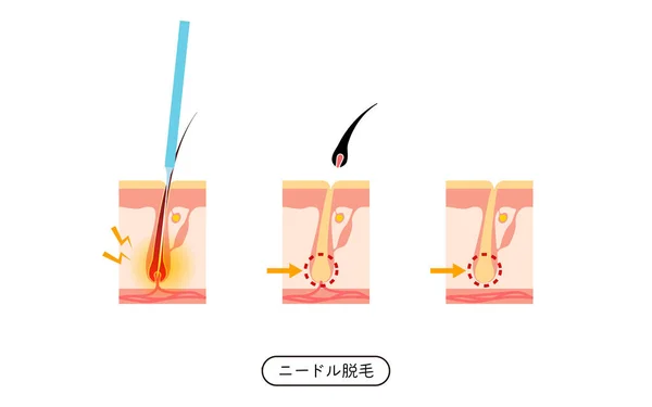 Image Hair Removal Process Hair Removal Needle Hair Removal Treatment — Vetor de Stock