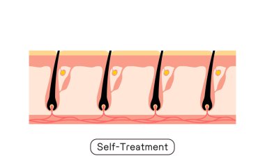 Tüyleri alındıktan sonra, kendi kendini tedavi etme görüntüsü.