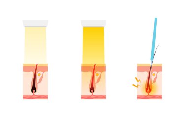 Image of Hair Removal, Esthetic Hair Removal, Medical Laser Hair Removal, Needle Hair Removal