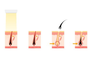 Kılların alınma görüntüsü, estetik tüy yolma tedavisinden sonra kılların alınma süreci.