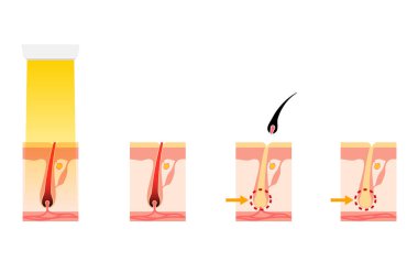 Image of hair removal, the process of hair removal after medical laser hair removal treatment