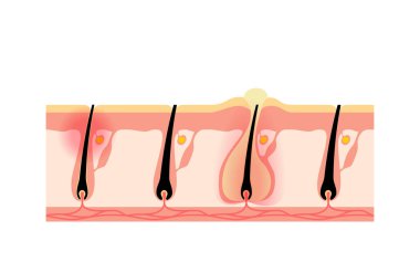 Image of hair removal, skin problems, rough skin from shaving hair yourself