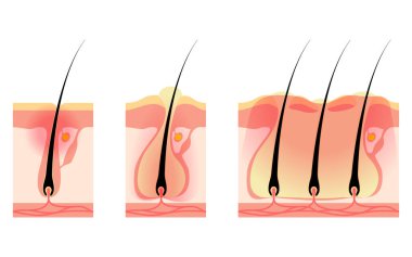 Image of skin problems, rough skin/acne, early to advanced folliculitis