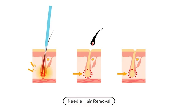 Image Hair Removal Process Hair Removal Needle Hair Removal Treatment — Vetor de Stock