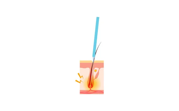 Image Hair Removal Process Hair Removal Needle Hair Removal Treatment — 스톡 벡터