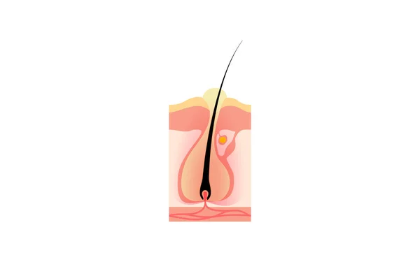 Illustration Worsening Furuncle Condition Worsened Folliculitis Pimple — Vector de stock