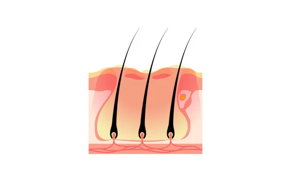 Illustration Carbuncle Subcutaneous Connection Multiple Furuncles Aggravated Folliculitis — Vetor de Stock