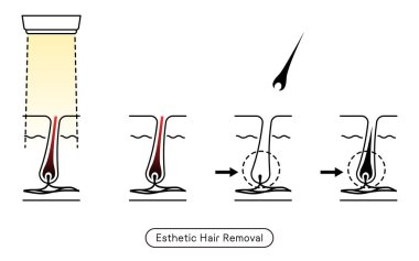 Image of hair removal, the process of hair removal after esthetic hair removal treatment