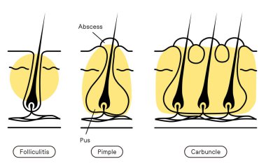 Image of skin problems, rough skin, acne, early to advanced folliculitis