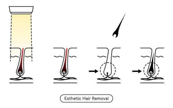 Image Hair Removal Process Hair Removal Esthetic Hair Removal Treatment — Vetor de Stock