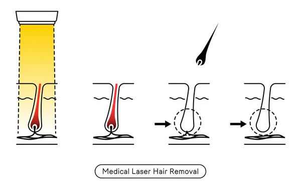Image Hair Removal Process Hair Removal Medical Laser Hair Removal — Vector de stock