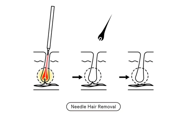 Image Hair Removal Process Hair Removal Needle Hair Removal Treatment — Image vectorielle