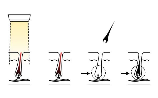 Image Hair Removal Process Hair Removal Esthetic Hair Removal Treatment — Wektor stockowy