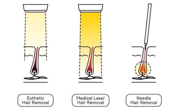 Image Hair Removal Esthetic Hair Removal Medical Laser Hair Removal — Vetor de Stock