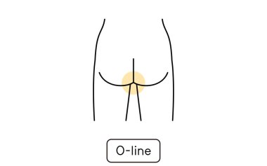 Hair removal illustration for women by part, O line
