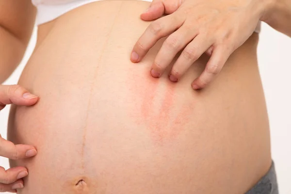 Nahaufnahme Schwangere Kratzt Ihren Großen Bauch Juckende Haut Unerkennbare Schwangerschaft — Stockfoto