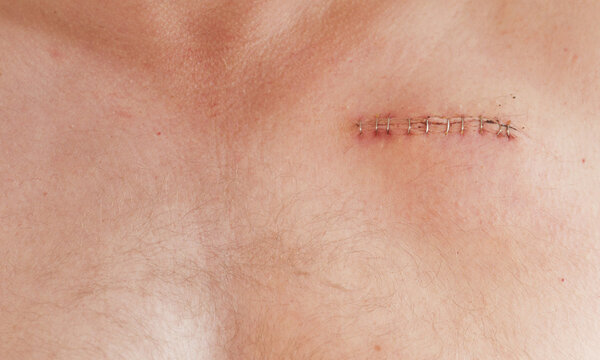pacemaker scar