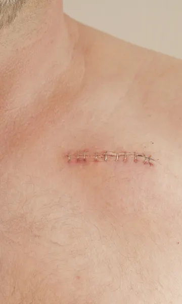 Pacemaker scar — Stock Photo, Image