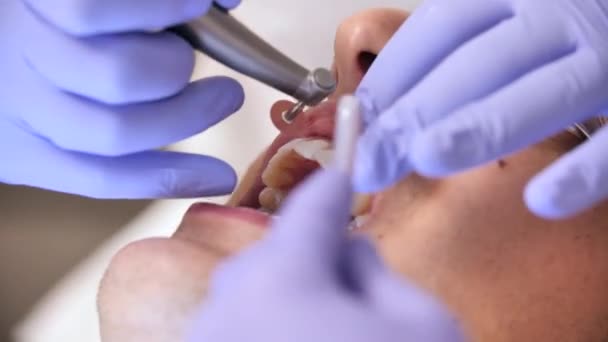 Close on Dentist Working on Patients Teeth — Stockvideo