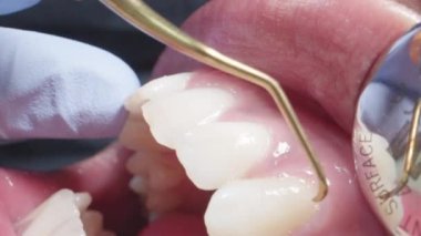 Macro Shot Dentist Working on Patients Teeth
